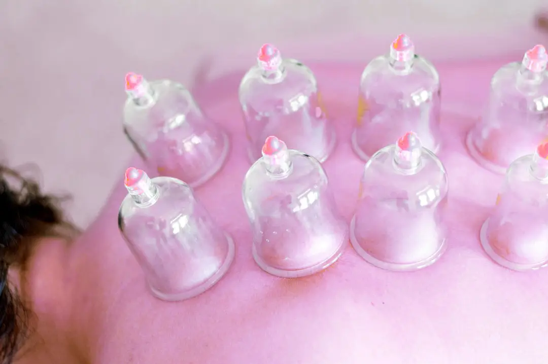 Female Fitness Trainer - Hijama Cupping Therapy