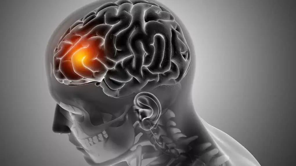Maurya Stroke Rehabilitation center (Physiotherapy in india)