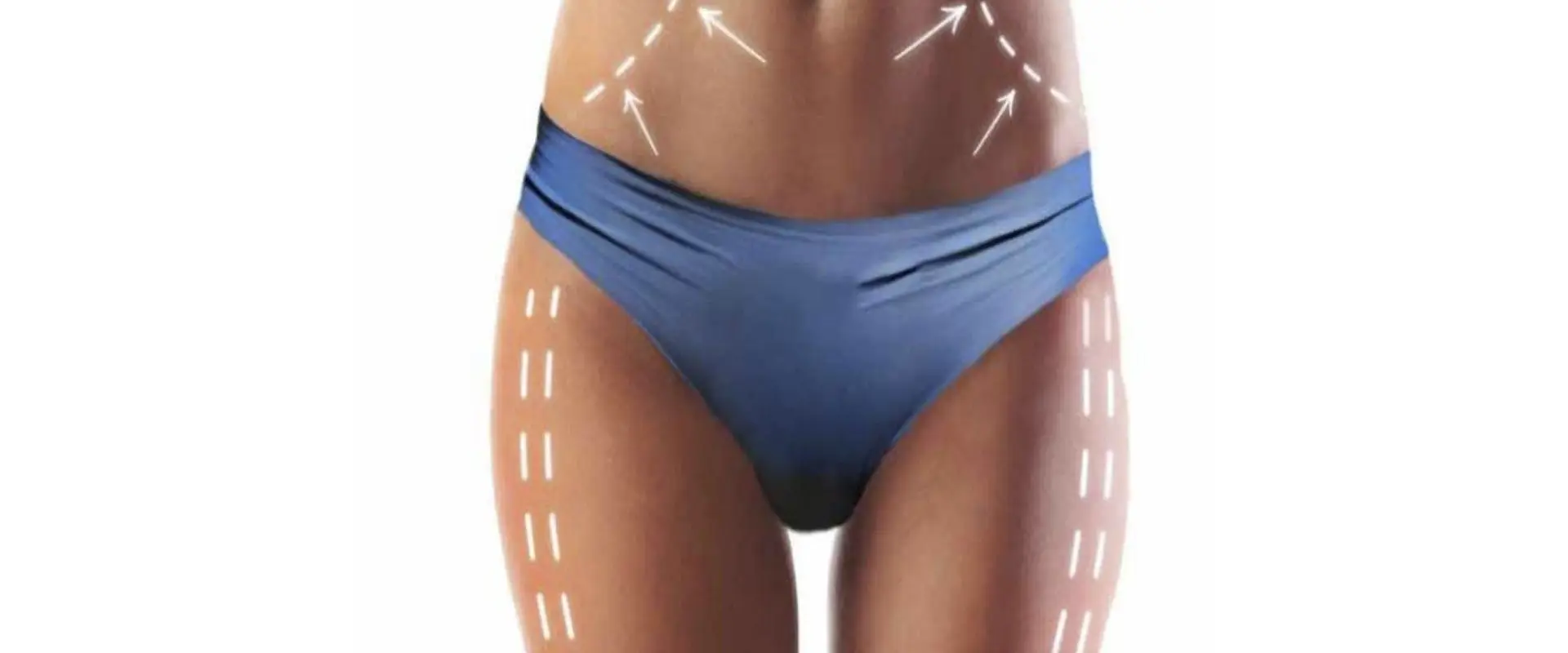 Cryolipolyse Nice | Centre Massena (Amincissement Nice - EMS - Electrostimulation - EMContouring)