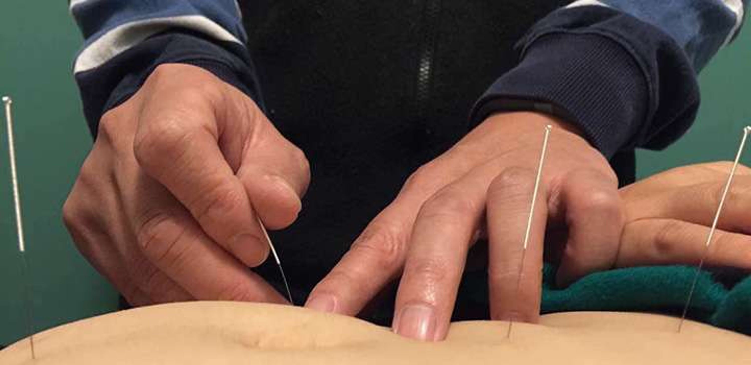 Peter Chen Acupuncture